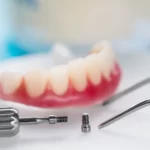 Implanty dentystyczne Szczecin