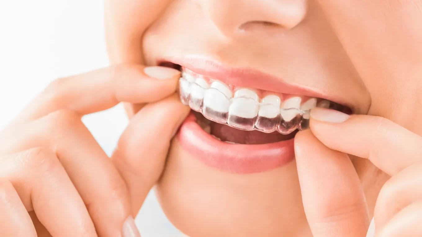 Invisalign dla kogo